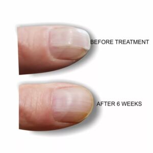 Fluoride Protein Calcium Treatment For Nails