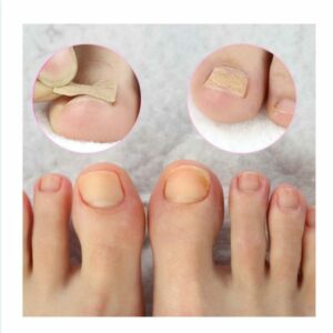 Pedicure Glue Free Toenail Patch 3pcs - Image 4